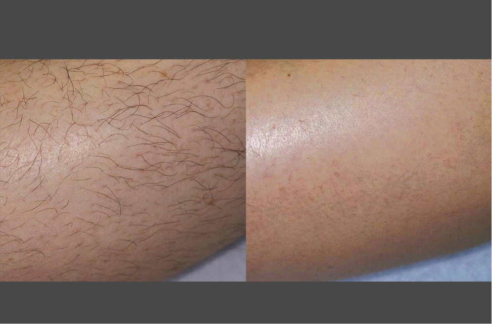 Before and after laser hair removal results