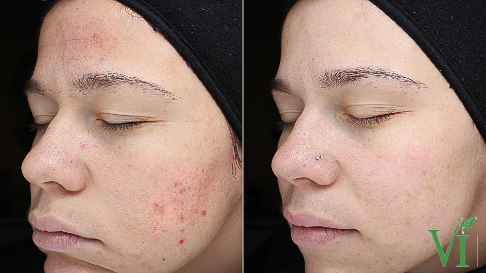Before and after VI Peel results for acne