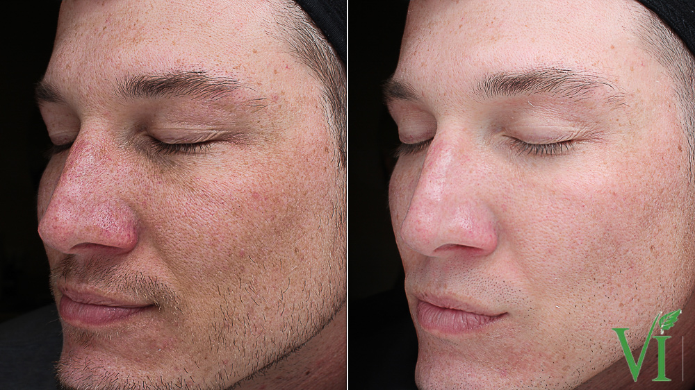 Before and after VI Peel results for pigmentation
