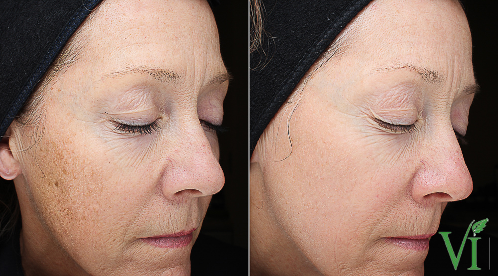Before and after VI Peel results for pigmentation