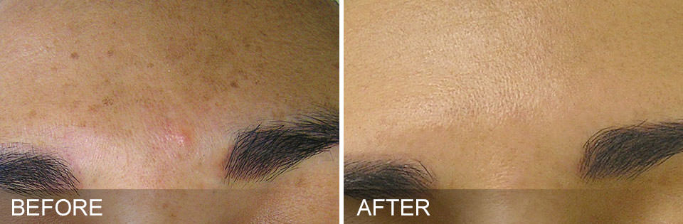 Before and after HydraFacial treatments