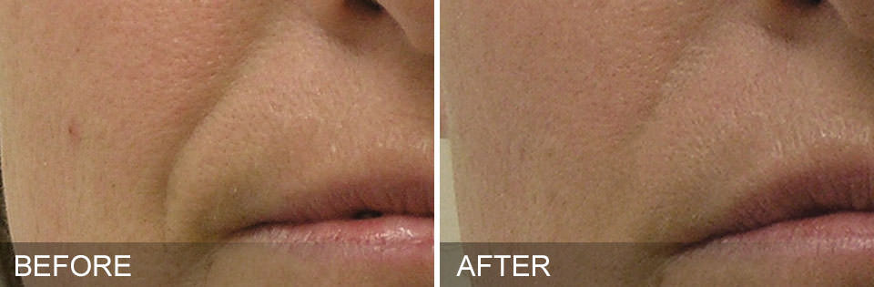 Before and after HydraFacial treatments