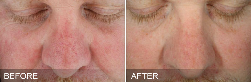 Before and after HydraFacial treatments