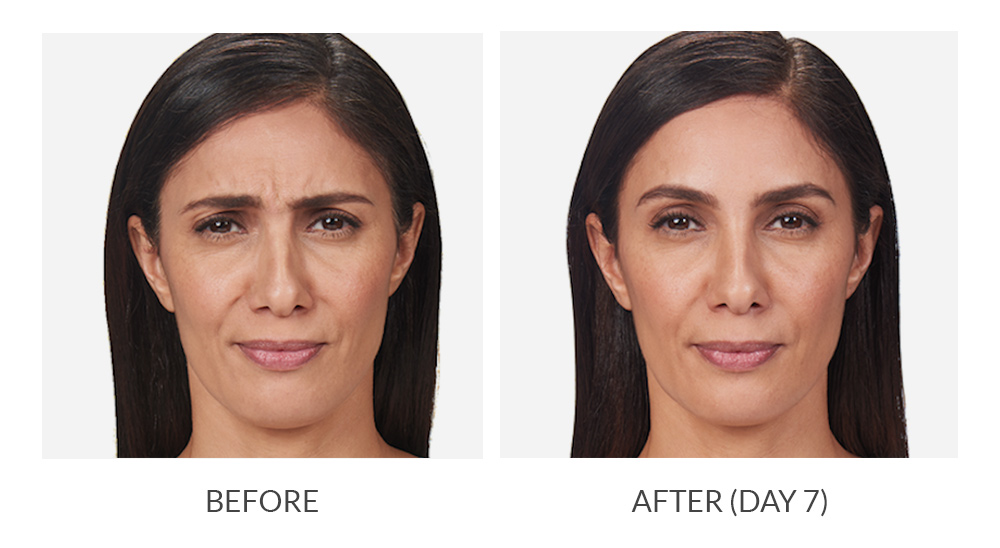 Before and after Botox results
