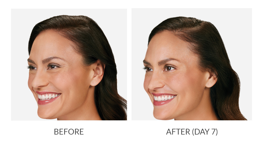 Before and after results for Botox