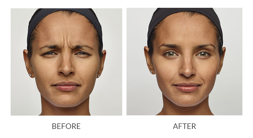 Before and after results for Dysport