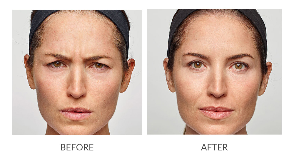 Before and after results for Dysport
