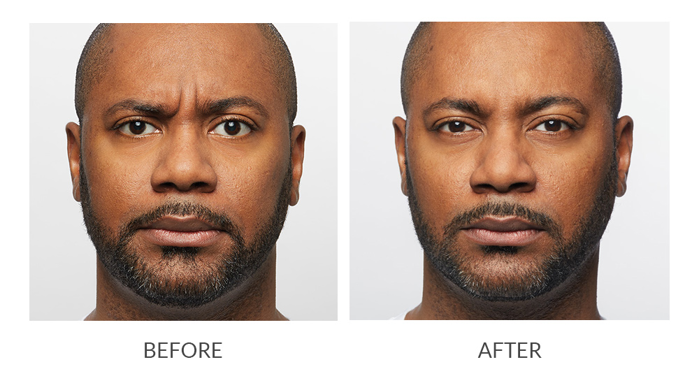 Before and after results for Dysport