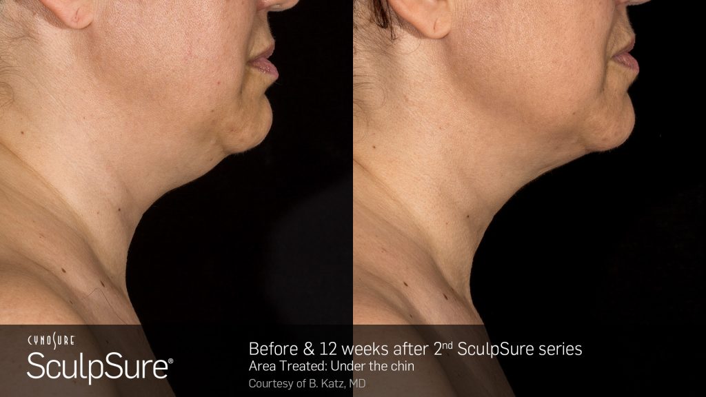 Before and after SculpSure results