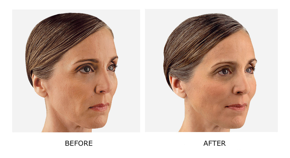 Before and after Juvéderm results