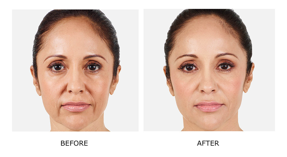 Before and after Juvéderm results