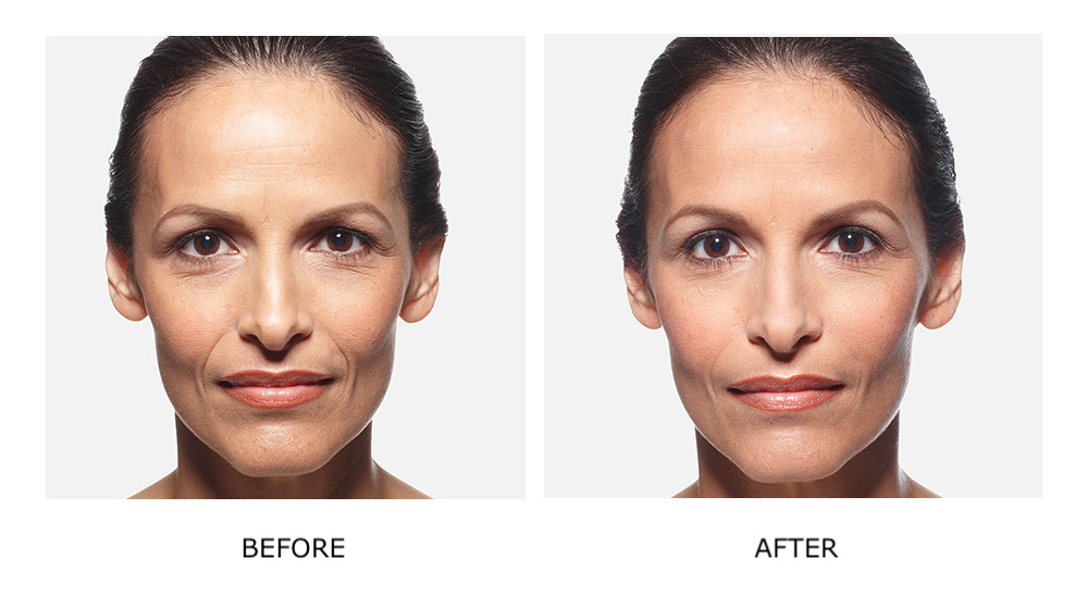 Before and after Juvéderm results