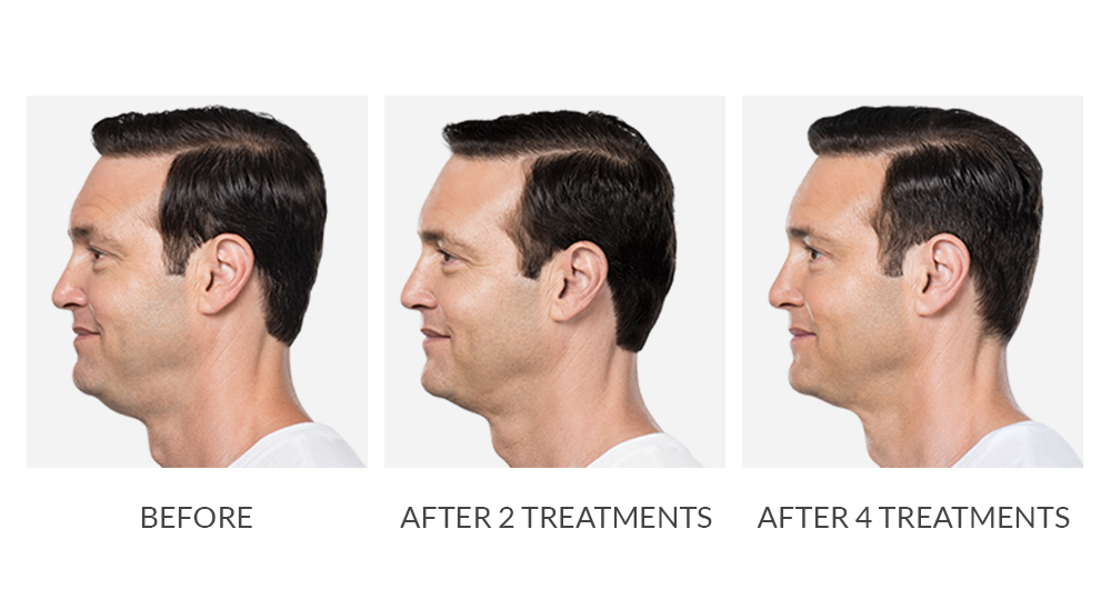Before and after Kybella treatments