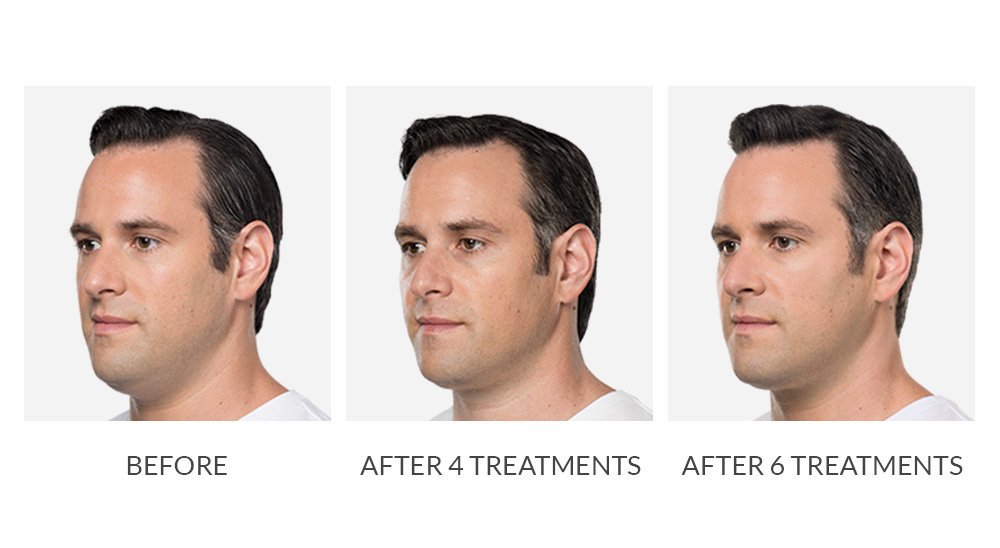 Before and after Kybella treatments