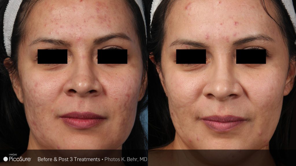 Before and after PicoSure results